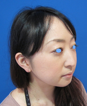目の下のたるみ、目のくまでお悩みの方、切らずに完璧に解決します。TCB-R法　手術直後　症例写真